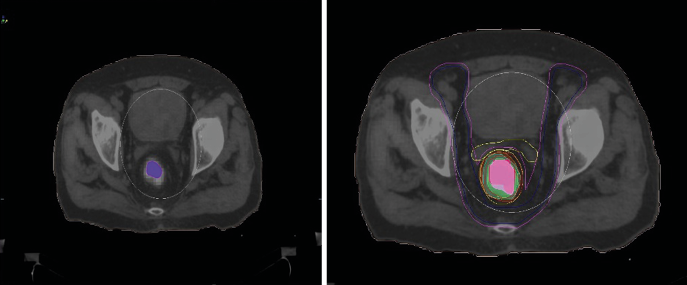 GTV según delineado en PET-CT.