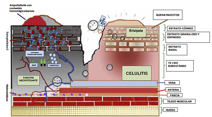 Figura 6. Mecanismo fisiopatológico de la erisipela, celulitis y
fascitis necrotizante.