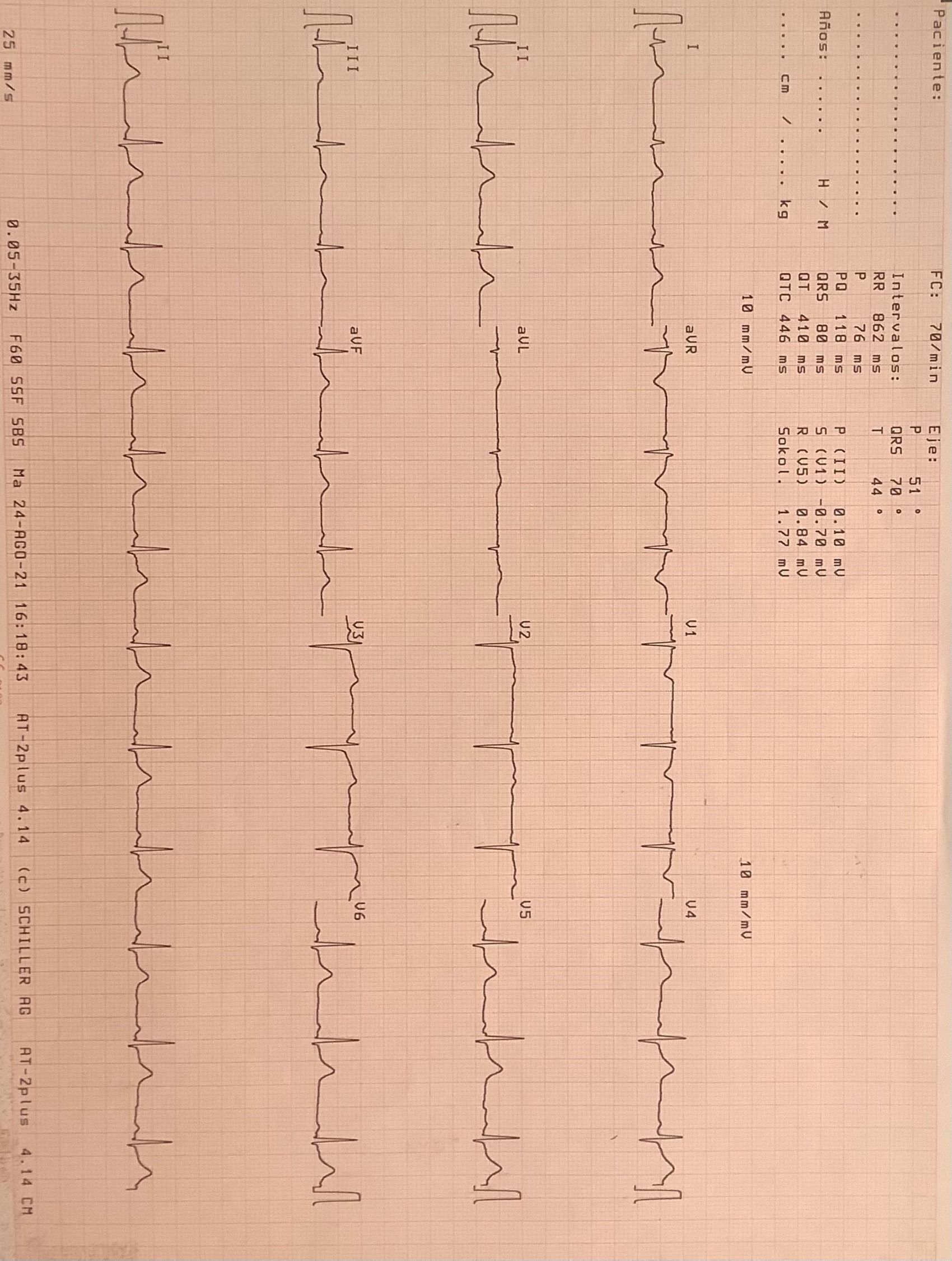 Figura 1. Electrocardiograma