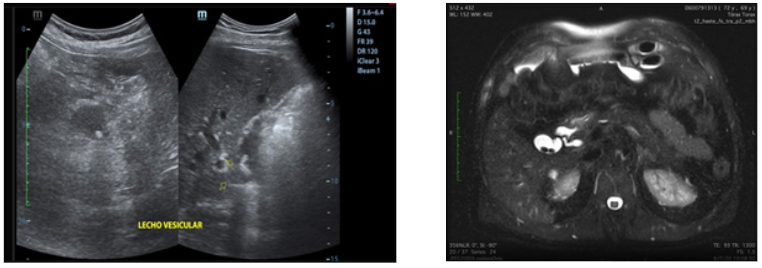 El lecho vesicular con presencia de imagen anecoica con
múltiples cálculos en su interior, el de mayor tamaño mide 6.5 mm, hallazgos
que ante el antecedente quirúrgico colecistectomía pudiera corresponder con
dilatación del conducto cístico. B. Corte axial: Flecha blanca muestra la
presencia de litiasis en remanente vesicular en resonancia magnética