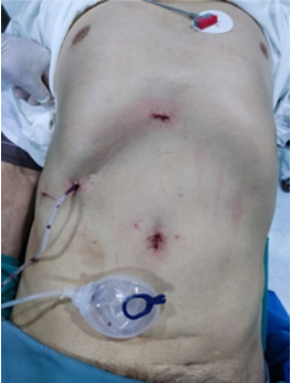 Se
aprecia cicatriz por colecistectomía abierta anterior, heridas de puertos
laparoscópicos, además de drenaje de Jackson Pratt