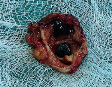 “Remanente
de vesícula biliar”, se evidencia pared de vesícula biliar de 4x3x0.5 cm, una
de sus caras es cruenta grisácea, la otra presenta mucosa blanquecina aplanada,
se distinguen dos cálculos facetados de composición mixta que miden entre 1 y
1.3 cm