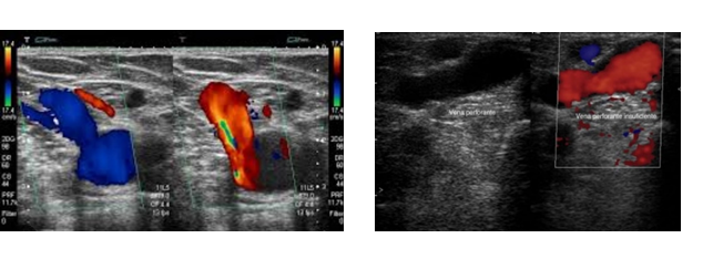 Ecograf&iacute;a Doppler venosa de miembro
inferior derecho