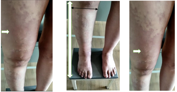  Nevus Hiperpigmentario en cara lateral de pierna y muslo derecho B