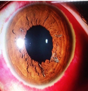 Retinografía del
segmento anterior ocular, que describe hiposfagma 360°, córnea transparente,
atrofia iridiana desde hora 2 a hora 7, con esclerosis cristaliniana nuclear
grado 1.