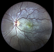 Retinografía, revela una lesión macular central de 1
disco de diámetro con fibrosis