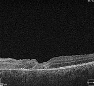 OCT del OI en el momento de
la presentación que muestra rotura de la unión de los segmentos internos y
externos de los fotorreceptores con el correspondiente aumento de la
reflectividad, infiltración de la pared retiniana y desprendimiento del
epitelio pigmentario retiniano. El grosor de la retina fue de 276 μm en el sitio de
la lesión