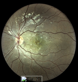 Retinografía,
persiste una lesión macular central de 1 disco de diámetro con fibrosis