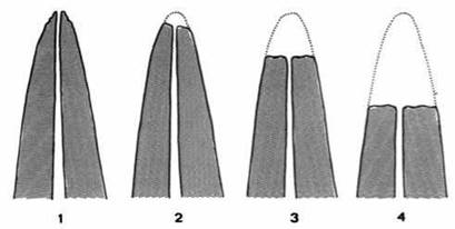 Figura 2. Índice de reabsorción radicular
para su evaluación
cuantitativa.