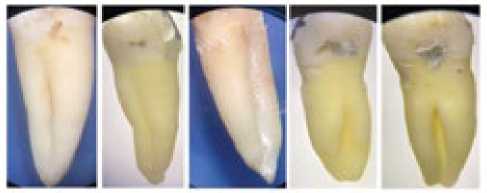 Figura 1. Presencia de SR
en primer premolar inferior.