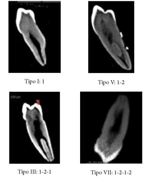 Figura 2. Tipos de clasificación de Vertucci
observados: corte V-L tomografía computarizada de haz cónico.