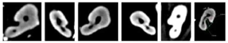 Figura 3. SR vistos en
corte axial CBCT.