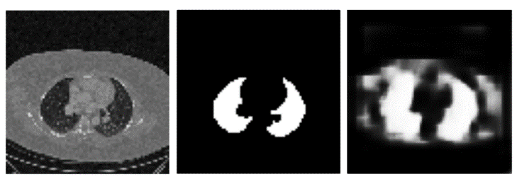 Computed tomography, equivalent
Ground Truth and prediction by U-Net, respectively, of the volume with
minimum DSC of testing data.