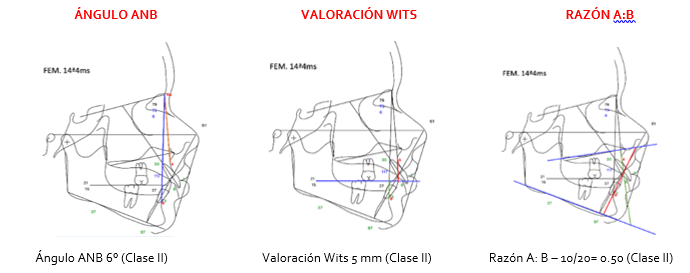 Diagnostico sagital intermaxilar del mismo paciente donde se observa la
relación intermaxilar, de acuerdo a los análisis del Ángulo ANB, Valoración
Wits y Razón A:B