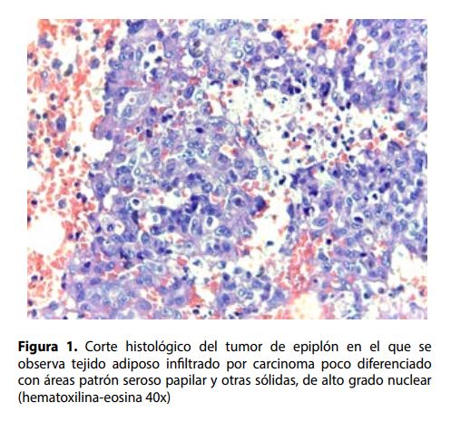 Corte histológico del tumor de epiplón en el que seobserva tejido adiposo infltrado por carcinoma poco diferenciadocon áreas patrón seroso papilar y otras sólidas, de alto grado nuclear(hematoxilina-eosina 40x) 
 
