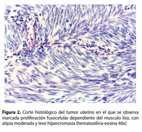 Corte histológico del tumor uterino en el que se observamarcada proliferación fusocelular dependiente del musculo liso, conatipia moderada y leve hipercromasia (hematoxilina-eosina 40x) 
