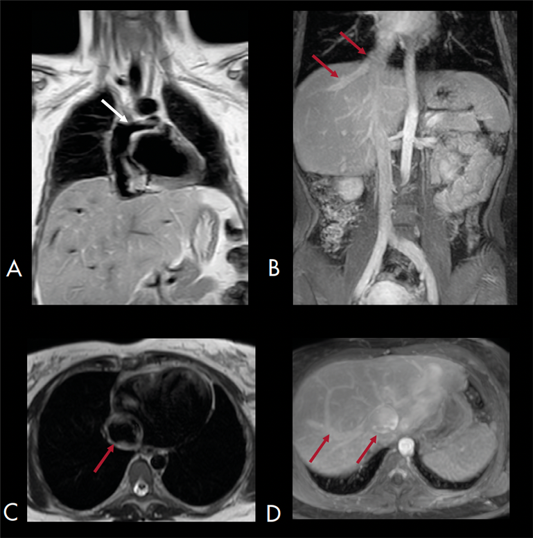 Resonancia magnética posterior a procedimiento de Fontan con circulación cavopulmonar tipo extracardiaco, comunicando el sistema venoso sistémico con la arteria pulmonar principal derecha (A) (flecha blanca). Prominencia de la vena cava inferior y de las venas hepáticas (B, C y D) (flechas rojas).