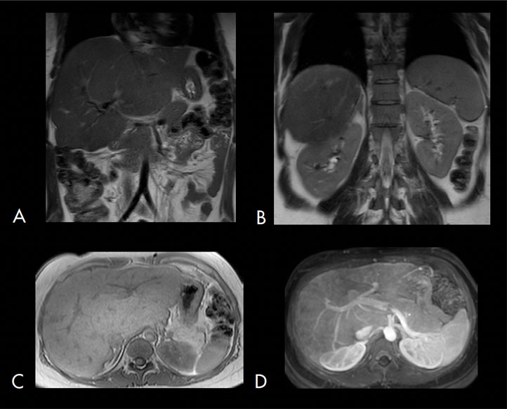 Resonancia magnética en la que se observan cambios morfológicos de hepatopatía crónica (cirrosis) manifestados por contornos lobulados e irregulares, redistribución del volumen parenquimatoso con prominencia del lóbulo caudado y atrofia del sector posterior del hemi-hígado derecho (A, B y C), sin signos de hipertensión portal, donde se aprecia bazo de tamaño normal sin ascitis, sin prominencia de la vena porta principal ni circulación colateral portosistémica (D).