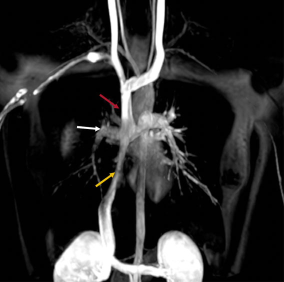 Secuencia de angiorresonancia con reconstrucción en proyecciones de máxima intensidad, donde se observan las anastomosis de la vena cava superior (flecha roja) y de la vena cava inferior (flecha amarilla) a la arteria pulmonar (flecha blanca).