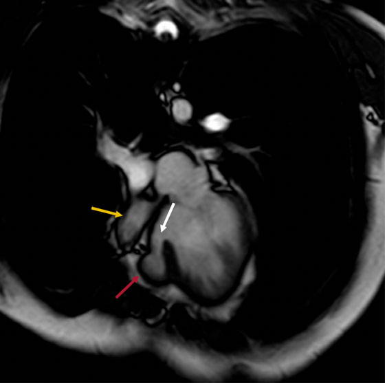 Secuencia de angiorresonancia T2, coronal oblicuo, donde se observa hipoplasia de la aurícula (flecha amarilla) y del ventrículo derecho (flecha roja), con ausencia de cone-xión atrioventricular derecha y comunicación interventricular perimembranosa (flecha blanca).