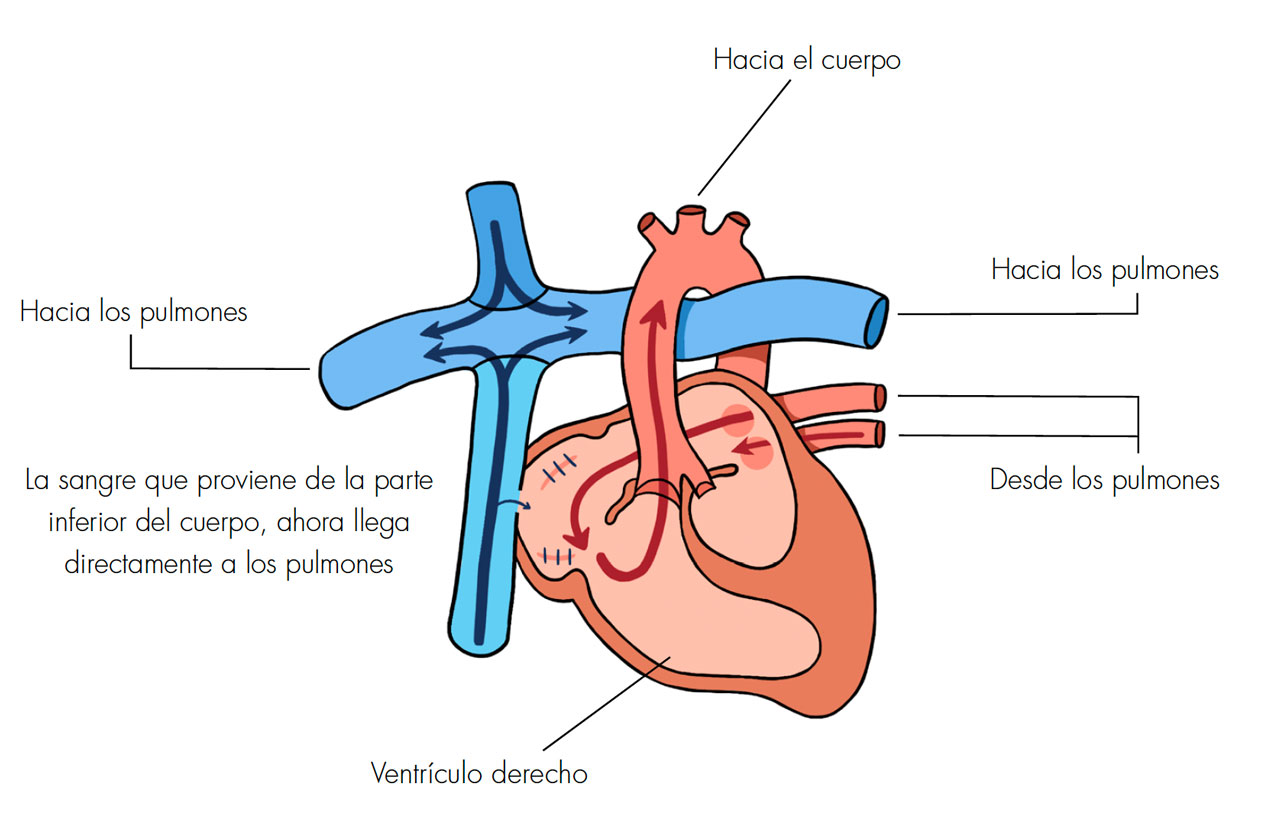Representación esquemática de los cambios circulatorios que se producen con el procedimiento de Fontan, donde hay exclusión del circuito cardiaco derecho con paso de flujo sanguíneo directamente a través de la arteria pulmonar, con la subsecuente pérdida del flujo pulsátil. La sangre es oxigenada en los alveolos respiratorios y desemboca en las venas pulmonares al circuito izquierdo, y posteriormente a la circulación sistémica.