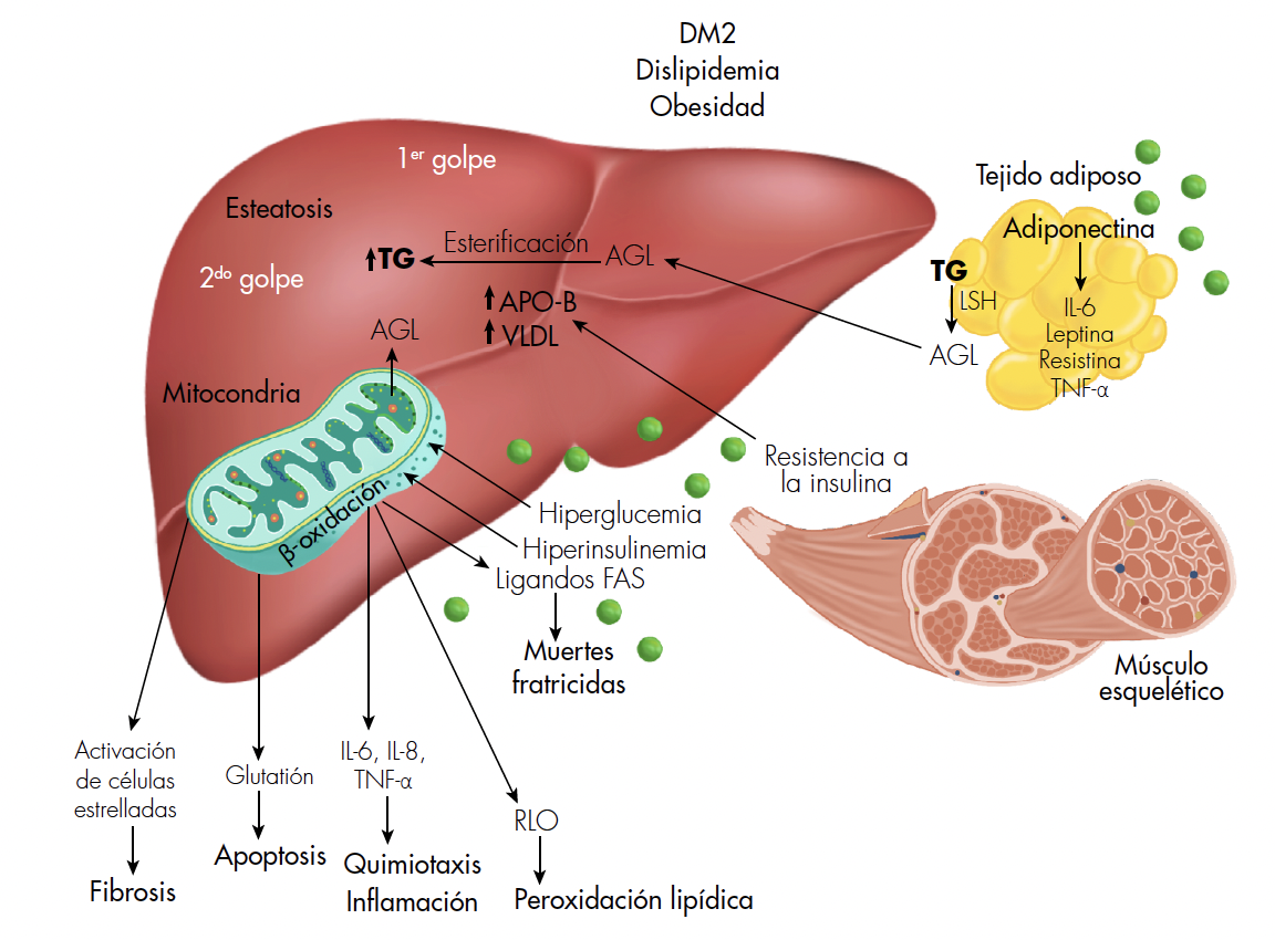 Fisiopatología de la EHGNA. DM2: diabetes mellitus tipo 2; AGL: ácidos grasos libres; RLO: radicales libres de oxígeno; TG: triglicéridos; LSH: lipasa sensible a hormona.
