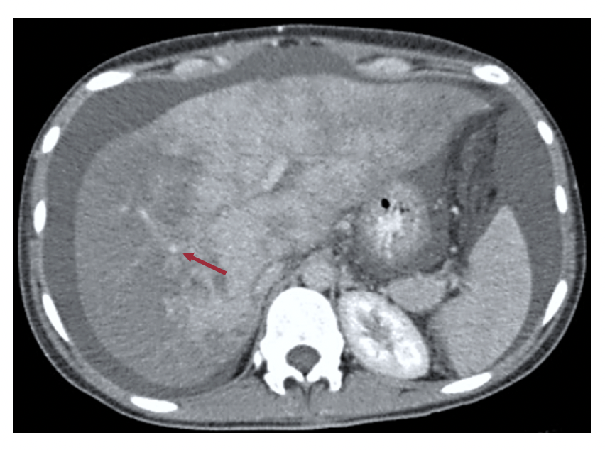 TAC de abdomen contrastada, en la que se observa defecto de llenamiento en venas suprahepáticas y parénquima hepático lobulado con áreas nodulares, las cuales presentan mayor realce con el medio de contraste en fases tardías, sugestivo de hiperplasia nodular regenerativa.