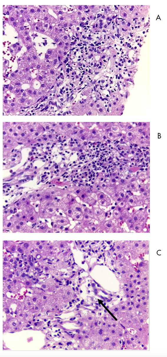 Colangitis biliar primaria. Proceso inflamatorio de pequeños ductos. (A) y (B) Fase inflamatoria. (C) Fase de ductopenia (H&E; 400x). Departamento de Patología, Universidad de Antioquia.