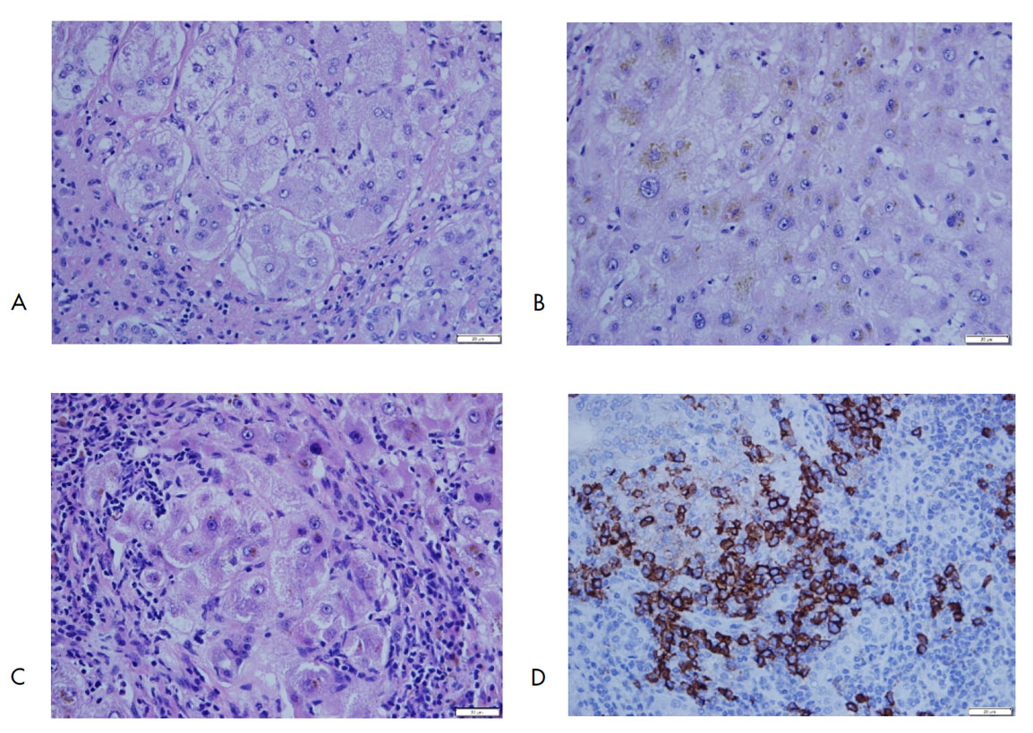 Hepatitis autoinmune. (A) Rosetas de regeneración (H&E; 400x), (B) colestasis intracitoplasmática (H&E; 400x), (C) hepatitis de interfaz (H&E; 200x), (D) inmunohistoquímica para CD38 positivo en células plasmáticas. Servicio de Patología, Hospital Pablo Tobón Uribe.