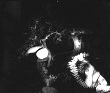 Colangiorresonancia. Severa deses-tructuración de la vía biliar intrahepática, con dilataciones y estenosis.