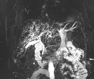 Vía biliar intrahepática completamente desestructurada, distorsión difusa de su arquitectura en ambos lóbulos hepáticos, con áreas de estenosis focal acompañadas de dilatación segmentaria.