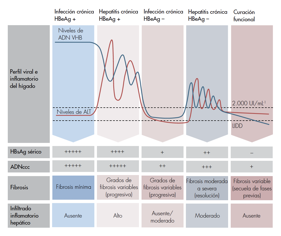 La historia natural de la hepatitis B crónica se describe a través de cuatro fases clínicas o virológicas de infección y/o hepatitis (según las guías de la Asociación Europea para el Estudio del Hígado de 2018), que finalizan con una curación funcional, definida por la pérdida sostenida del antígeno de superficie de la hepatitis B (HBsAg) con o sin anticuerpos anti-HBs. La elevación de la alanina aminotransferasa (ALT) está presente durante las fases de la hepatitis crónica positiva o negativa para el antígeno “e” de la hepatitis B (HBeAg), en tanto que sus valores son normales en las fases de infección crónica positiva o negativa para el HBeAg. Durante las fases negativas para el HBeAg, se cree que el HBsAg se produce preferentemente a partir de las secuencias integradas de ADN del virus de la hepatitis B (VHB), aunque el ADN circular covalentemente cerrado (ADNccc) se puede detectar. Dependiendo del equilibrio entre la replicación viral y el control inmunitario, los pacientes pueden pasar de una fase a la otra, y estas fases no necesariamente suceden de manera secuencial. Los niveles de ADNccc disminuyen con el tiempo, pero nunca se eliminan por completo. Sin embargo, los niveles séricos de HBsAg sí van disminuyendo. Se cree que la integración del genoma viral aumenta con la duración de la infección, al igual que la proporción del HBsAg expresado a partir de secuencias virales integradas. LIDD: límite inferior de detección. Tomado y adaptado de [10].