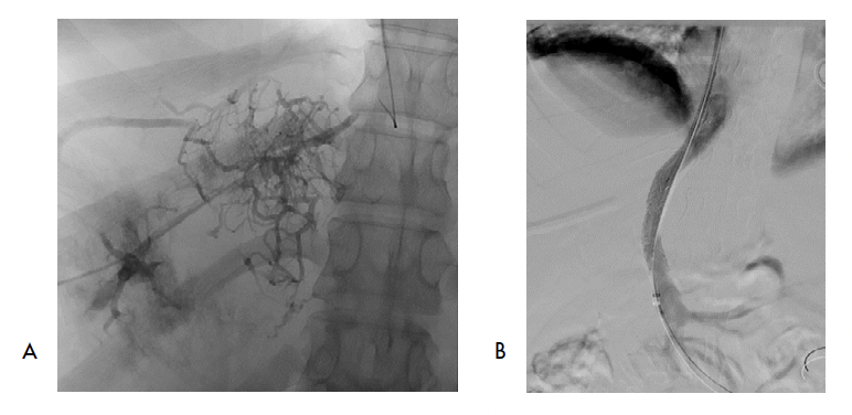 Paciente joven con SBC (número 3), con várices esofágicas secundarias a hipertensión portal. La única vena posible de cateterizar por vía yugular fue la izquierda (media y derecha ocluidas). A) Se puede ver la estenosis severa del tracto de salida y la formación de colaterales. B) Tratamiento con TIPS de vena hepática izquierda a porta izquierda.