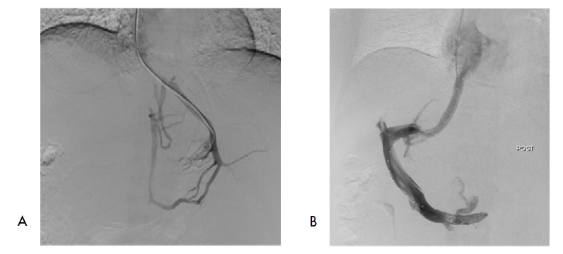 Paciente con SBC (número 4), remitida para manejo intervencionista por ascitis refractaria. A) Venografía hepática percutánea que demuestra obstrucción completa del tracto de salida y formación de gran red de venas colaterales intrahepáticas. B) Tratamiento exitoso con TIPS.
		
		
			