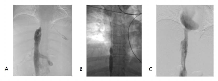 Paciente joven. A) Budd-Chiari por obstrucción de la VCI-SH. B) Recanalización exitosa con angioplastia. C) Implantación del stent.