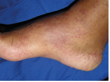 Púrpura. Máculas puntiformes violáceas en región distal de extremidades inferiores secundarias a inflamación intensa de las vénulas y arteriolas.
