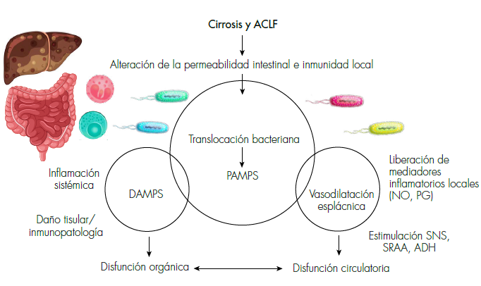 Fisiopatología inflamatoria de la cirrosis descompensada (CD) y la falla hepática aguda sobre crónica (ACLF). El evento inicial es la alteración de la permeabilidad intestinal que facilita la traslocación bacteriana y la entrada de PAMPS (patrones moleculares asociados a patógenos) desde el lumen intestinal hasta la sangre. A nivel local facilita la liberación de mediadores inflamatorios como óxido nítrico (NO) y prostaglandinas (PG), que llevarán a la vasodilatación esplácnica y la estimulación de sistemas reguladores: SRAA (sistema renina angiotensina aldosterona), SNS (sistema nervioso simpático) y ADH (hormona antidiurética), que perpetuarán la traslocación bacteriana y la vasodilatación esplácnica. También habrá una intensa inflamación sistémica que puede ocasionar liberación de DAMPS (patrones moleculares asociados a daño), daño tisular colateral (inmunopatología) y disfunción orgánica múltiple.